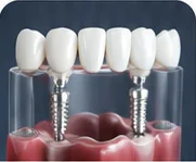All on 4 Implants at Key Smile