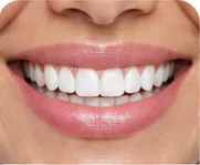 Veneers at Key Smile