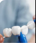 Teeth Whitening at Key Smile