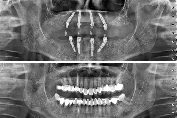 زراعة All on 4 at Key Smile