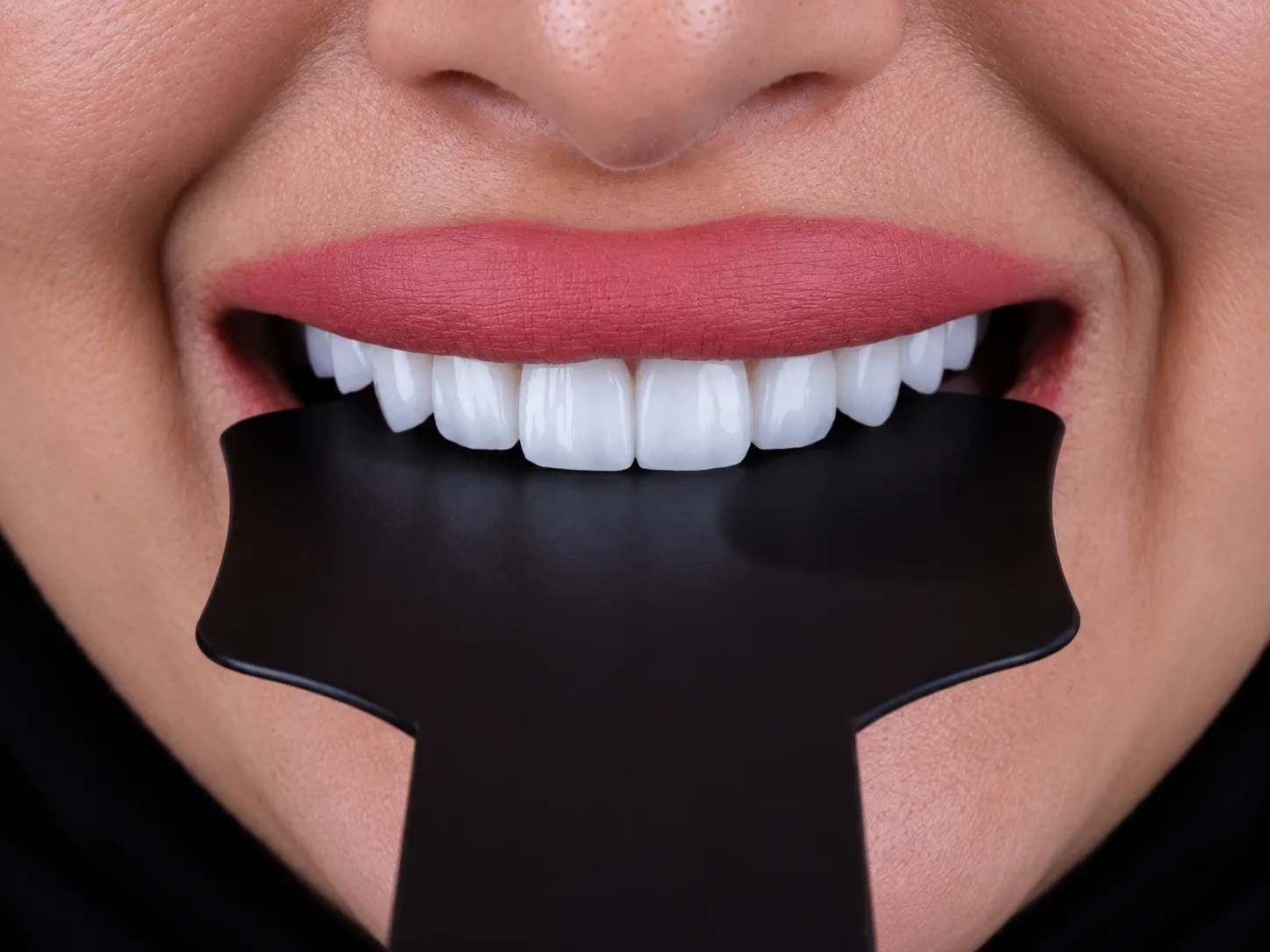 الفينير at Key Smile